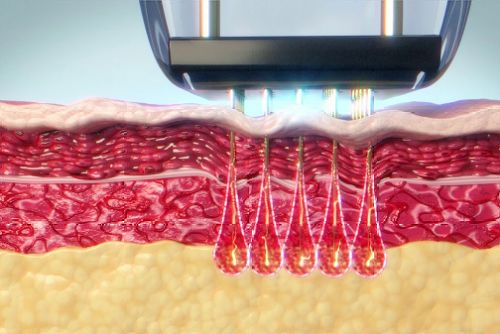 OEM RF Microneedling-maskiner: En guide til distributører af skønhedsudstyr